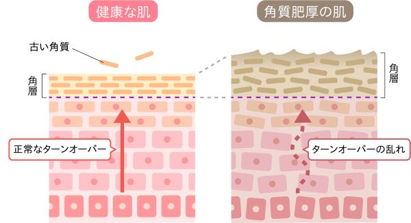 健康な肌と角質肥厚の肌