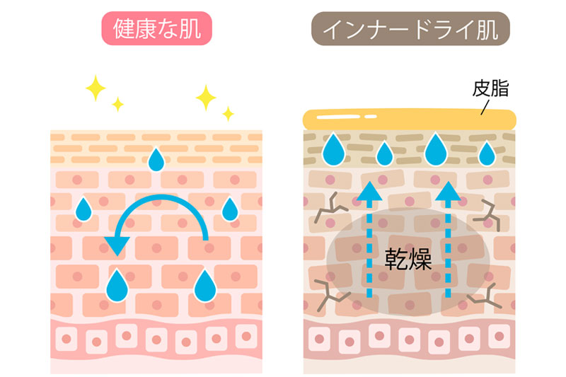 そもそもインナードライ肌とは?